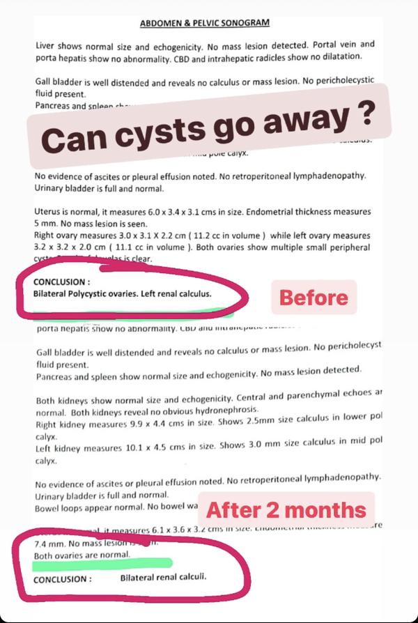 Sonography report before showing bilateral polycystic ovaries, and after 2 months showing both ovaries normal